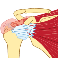 Rotator Cuff and Bursitis