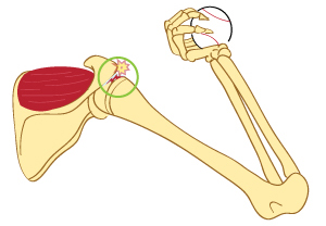 What is Supraspinatustear Tendonitis