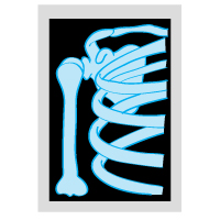 Can Rotator Cuff Tendonitis Be Detected on X-Rays?